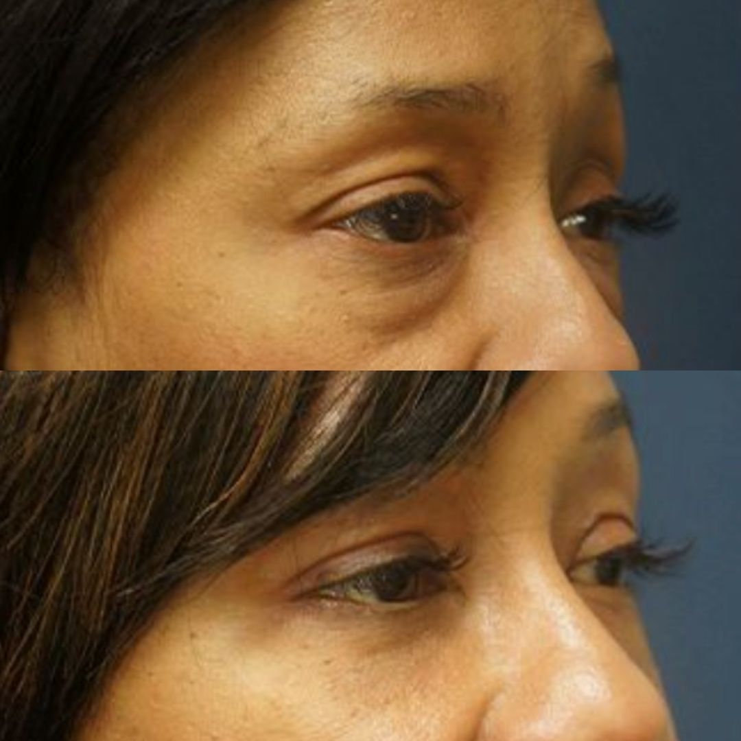 Before upper blepharoplasty