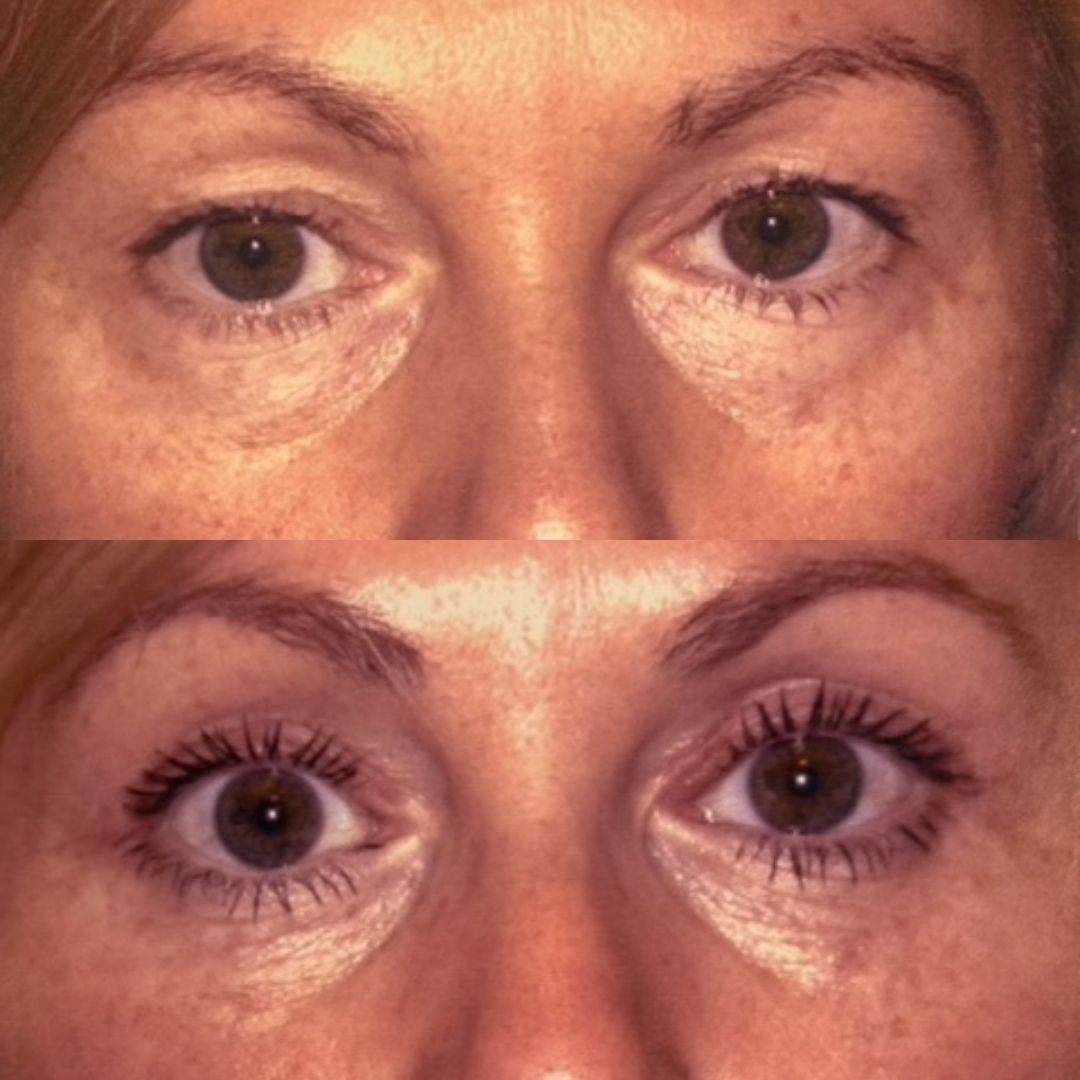 Before lower blepharoplasty