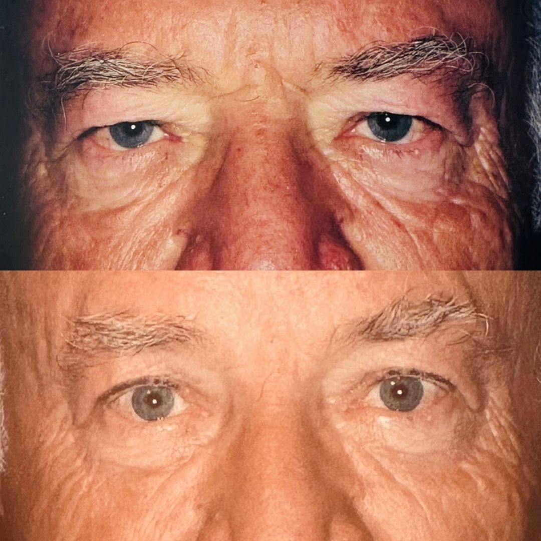 Before CO2 laser periocular