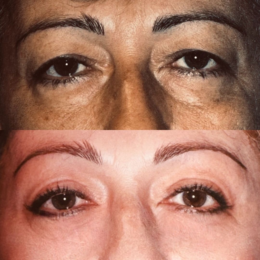 Before full eyelid rejuvenation